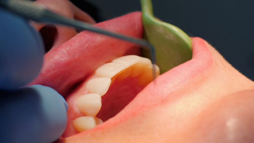 Close-up of inflamed gums showing early signs of gum disease in Medford OR patient
